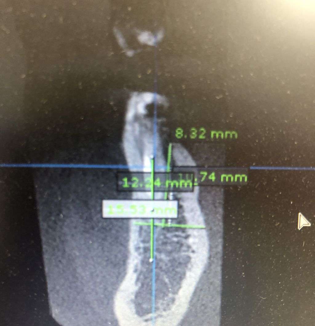 Oralna kirurgija s implantologijom - 