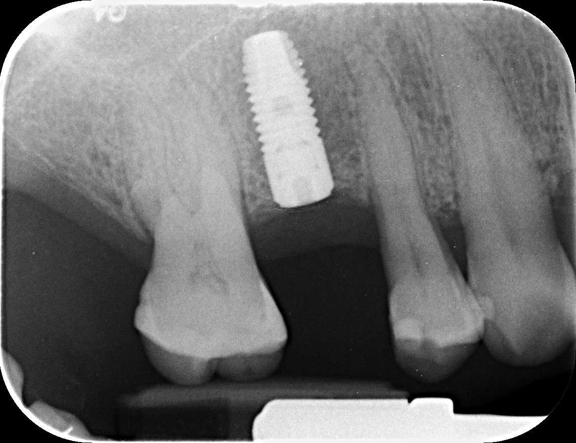 Oralna kirurgija s implantologijom - 