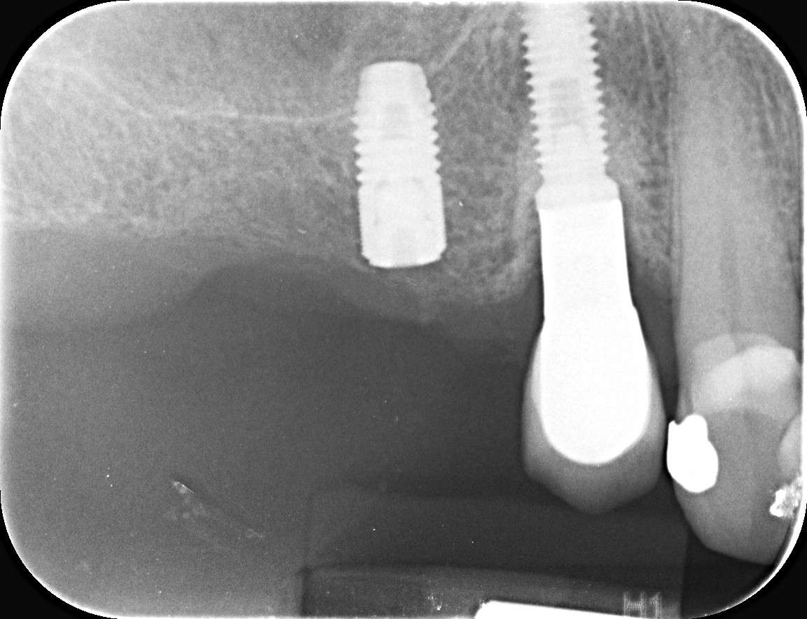 Oralna kirurgija s implantologijom - 